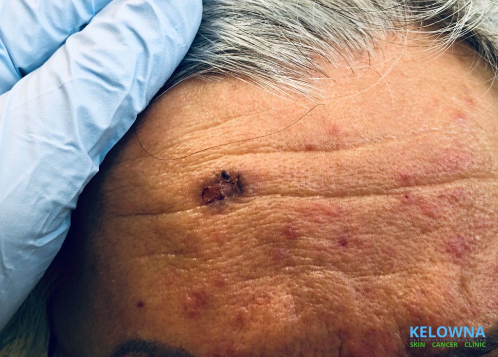 65 Year Old Female with a Basal Cell Carcinoma on her Forehead