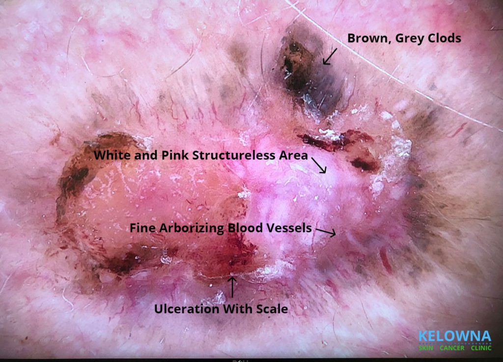 Close up of dermoscopic view of Basal Cell Carcinoma lesion with characteristics labelled.