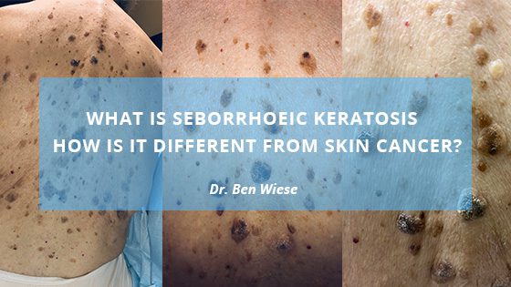 What Is Seborrhoeic Keratosis Kelowna Skin Cancer Clinic