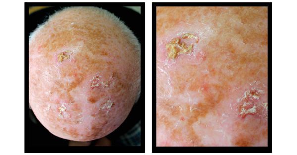 Can The Sun Kill Pre-Cancerous Lesions? post thumbnail