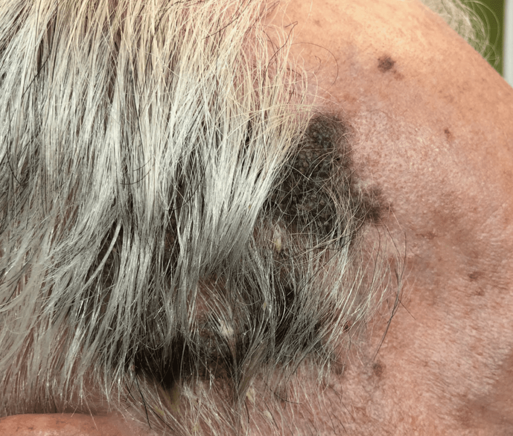 Seborrhoeic keratosis shown on an elderly man's scalp.